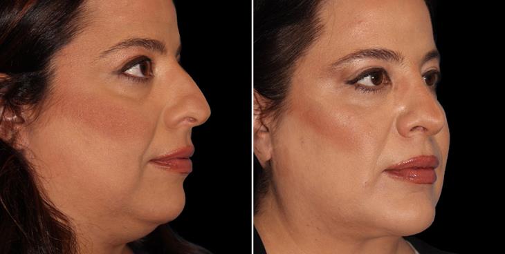 Atlanta GA Scarless Nose Surgery Results ¾ Right View